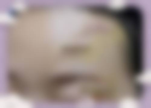 面部青春痘疤痕怎么治疗？找欧富强医生，做点阵激光修复更有效