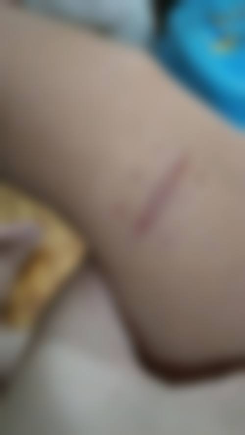 疤痕性痘痘怎么消除？杜荣昌医师坐诊 点阵激光+日常护理双效修复