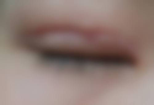 疤痕性痘痘怎么消除——齐齐哈尔绣颜医疗美容门诊部