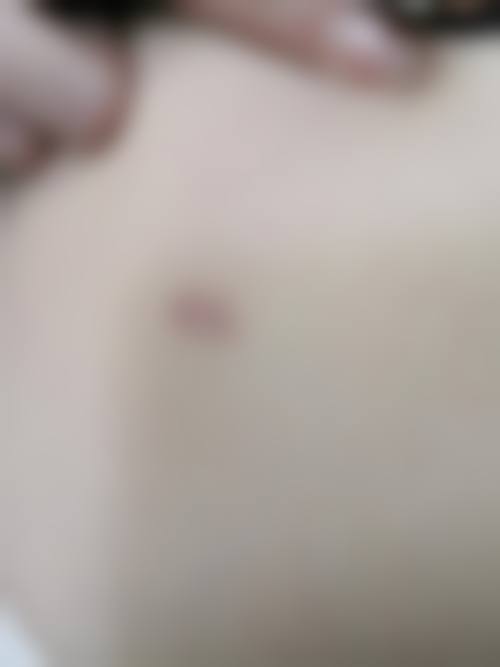 疤痕性痘痘怎么消除——上海交通大学医学校苏州九龙医院皮肤美容中 心