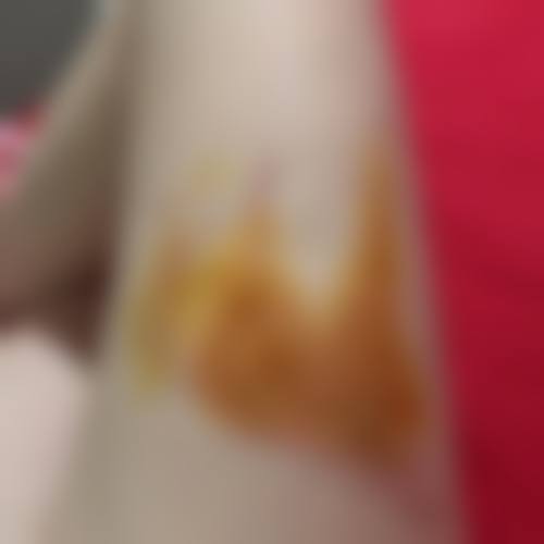 烫伤的疤痕怎么能去掉——广州曙光医学美容医院