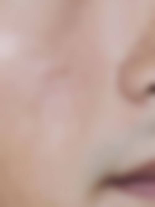 疤痕性痘痘怎么消除——黑龙江瑞丽医疗美容医院