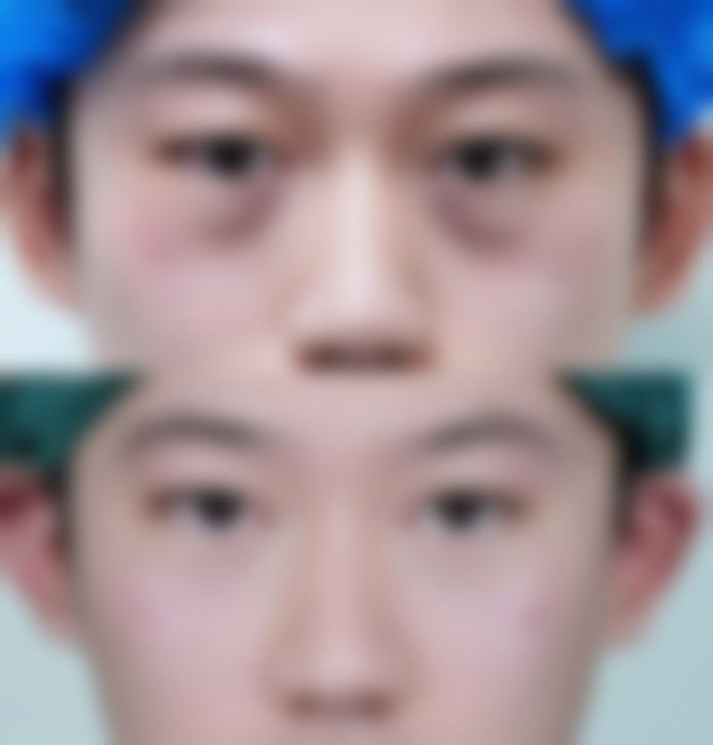 怎么除顽固的眼袋——广西中 医 药大学第一附属医院整形科