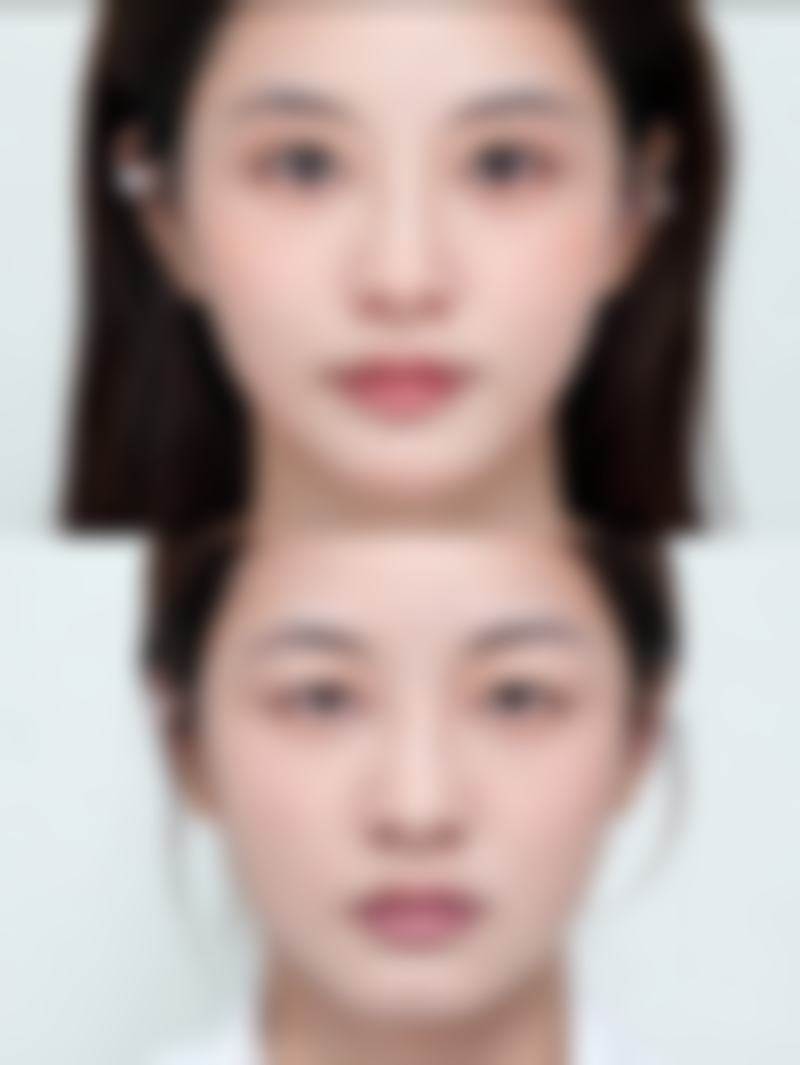 面部拉皮除皱价格大揭秘