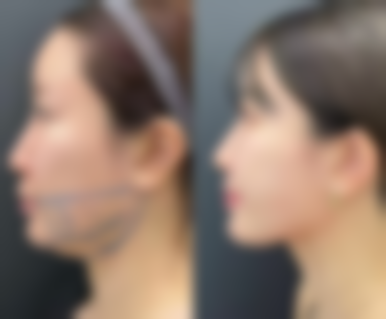 半肋骨隆鼻子是恒久的吗之医院与医生技术因素