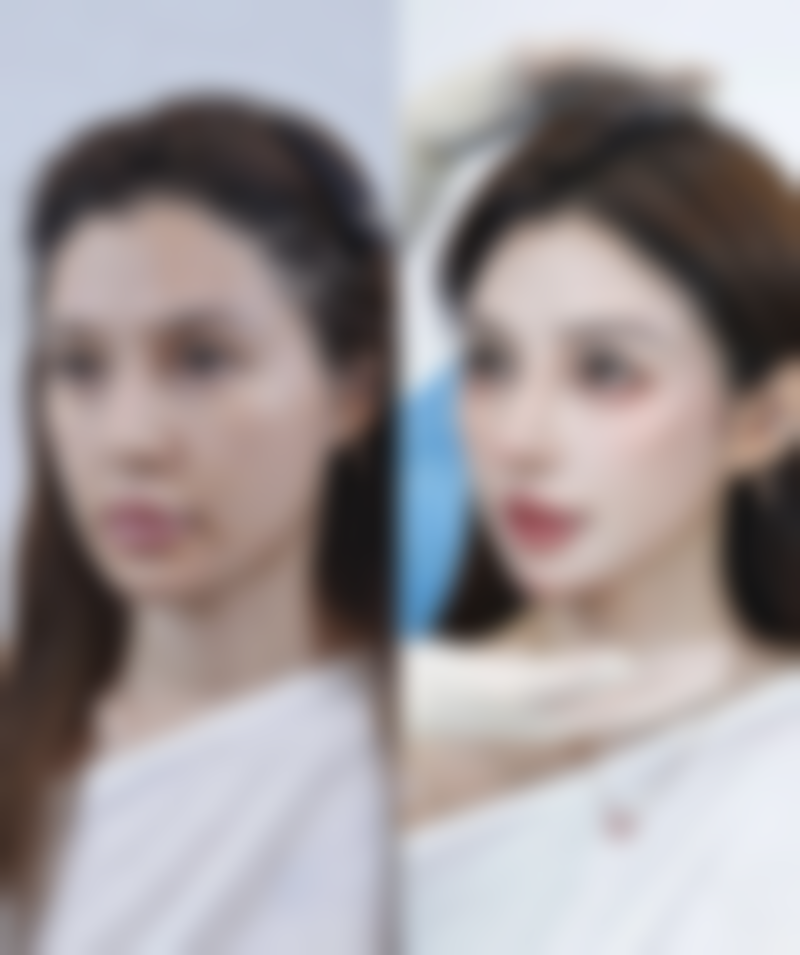 半肋骨隆鼻子是恒久的吗之恒久保持的条件