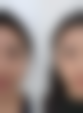 如何更好快速除去眼袋——大连达美元辰医疗美容门诊部