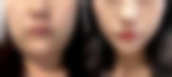 割双眼皮可以熬夜吗有影响吗——成都华美紫馨整形医院