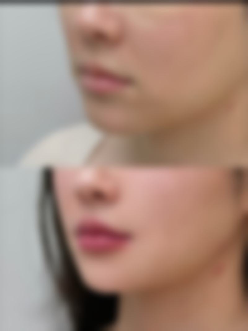 半肋骨隆鼻子是恒久的吗之术后护理关键因素