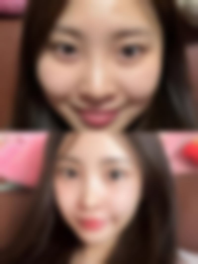 如何更好快速除去眼袋——重庆千叶眼科医院