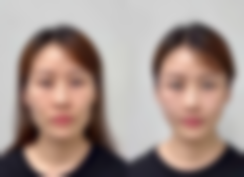 半肋骨隆鼻的“恒久”哲学