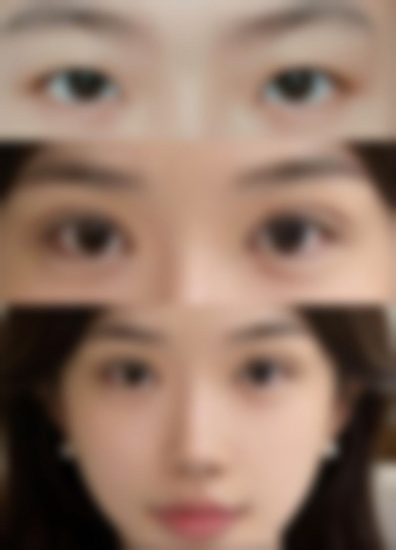 黑眼圈黑眼袋怎么去——上海健丽医疗美容门诊部