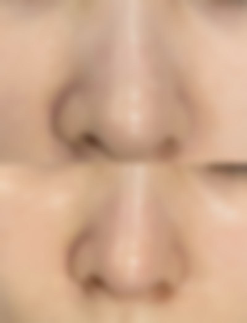 怎么样可以治疤痕——韩国维摩整形姜在九