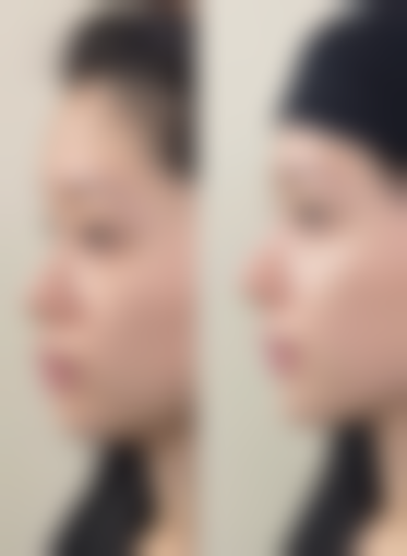 怎么样可以治疤痕？名医定制专属方案+SRT浅放抑疤抗复发