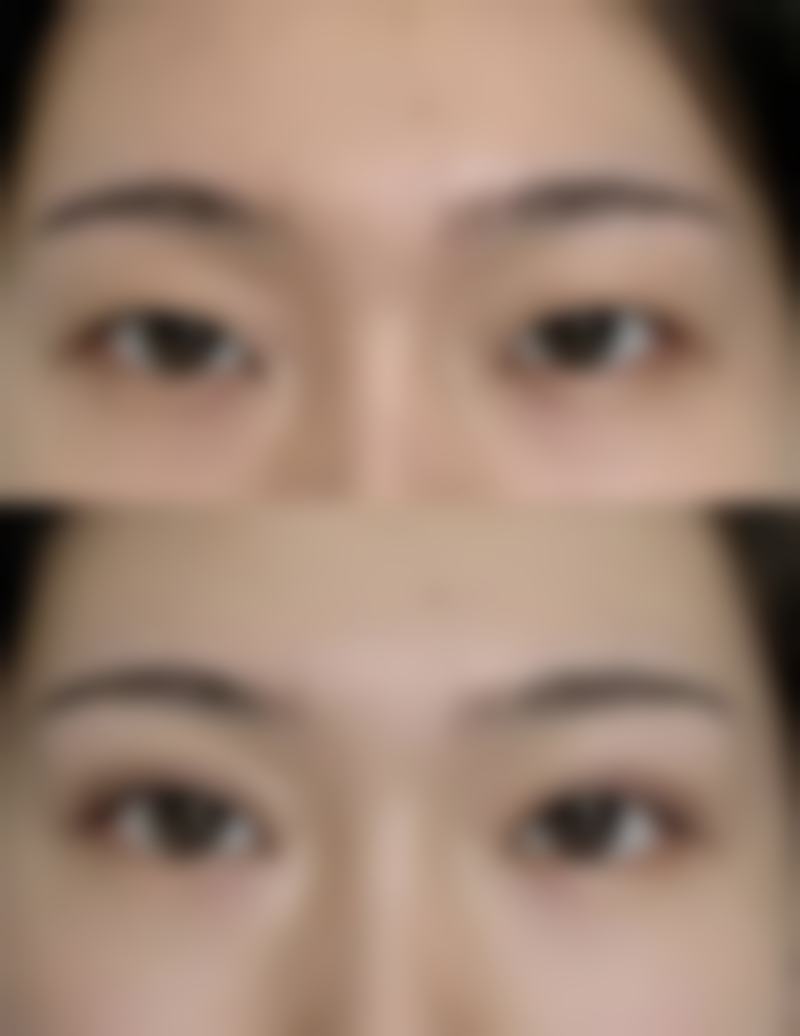 黑眼圈黑眼袋怎么去——北京美诗沁医疗美容医院