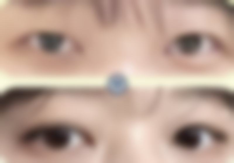 其他擅长修复的机构在做完双眼皮眼睛和眉毛更近了怎么办上的表现
