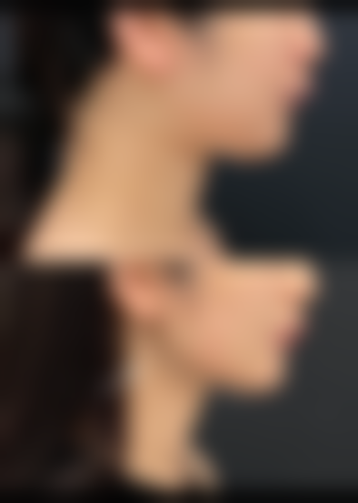 如何更好快速除去眼袋——广西桂美汇医疗美容门诊部