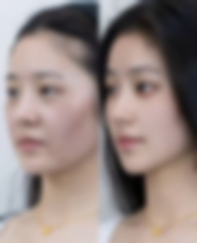 脸上疤痕黑印会自然淡化吗——脸部娇嫩肌肤的特殊考量