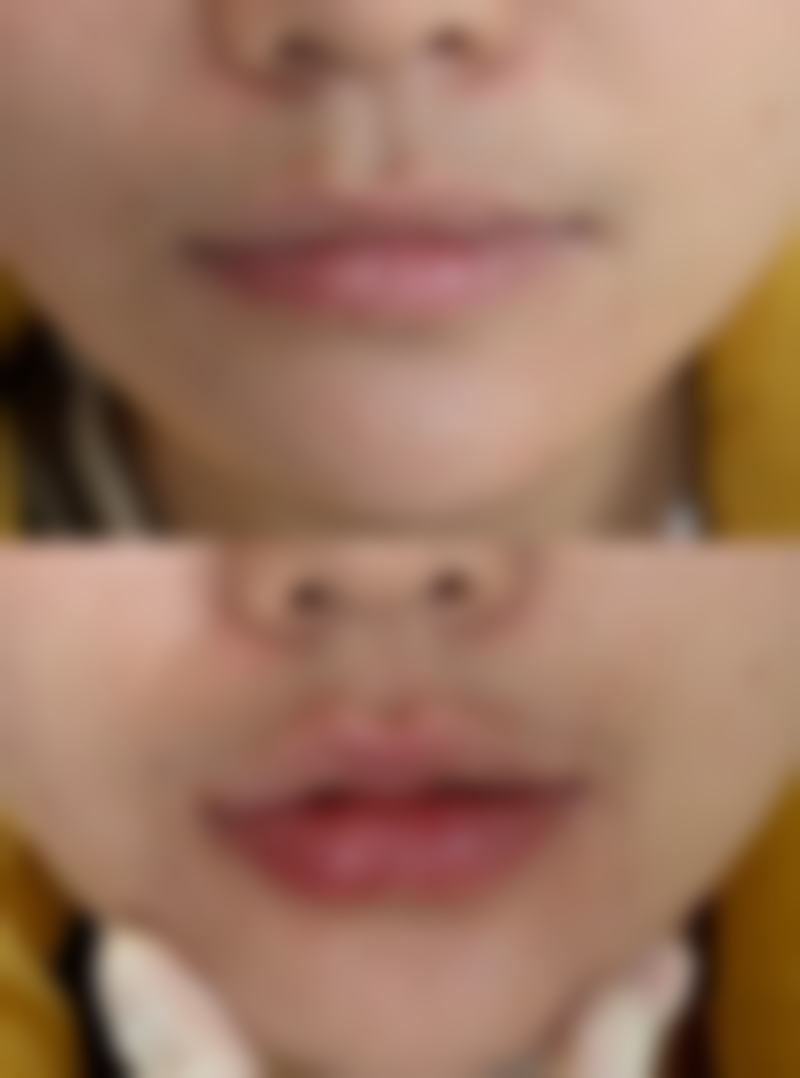 眼袋大可以抽脂吗？三甲医院专业吸脂+美容医院术后护理全解析