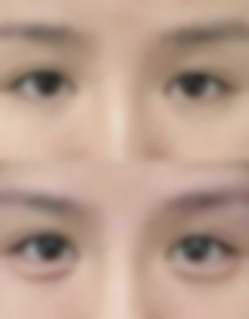 做完双眼皮眼睛和眉毛更近了怎么办——北京韶华医疗美容医院