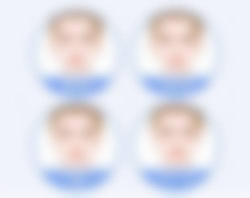 隆胸假体取出会造成疤痕增生吗