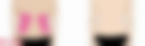 隆胸手术时间要多久之自体脂肪隆胸