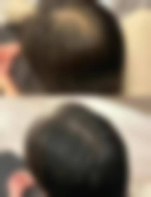 头发种植究竟好不好——西安沐森自然植发