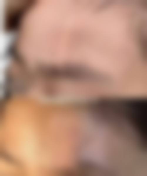 合肥华美整形外科医院:点阵激光祛疤治疗手术伤口疤痕增生