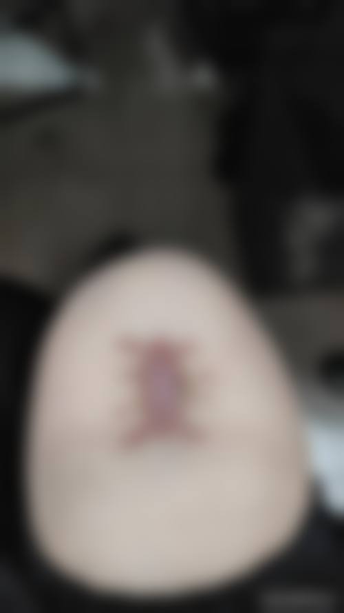 郑州第二中医院胎记疤痕科:经验医生助力手术伤口疤痕增生治疗