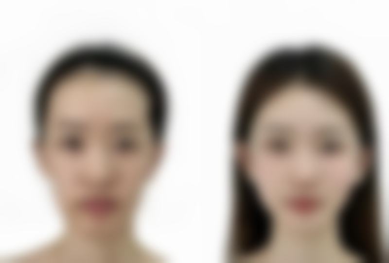 甲亢手术疤痕怎样修复的好:吃出来的无痕美颈秘籍