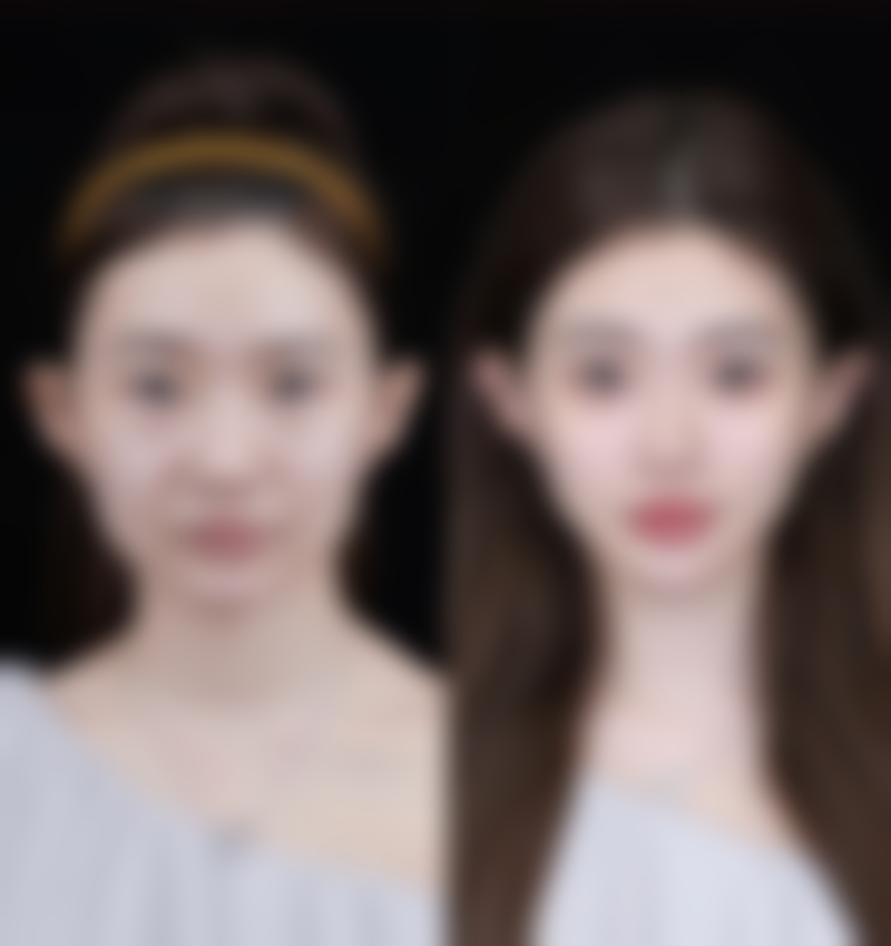 怎么判定自己是不是疤痕体质之骨干医生建议：遵循专精指导