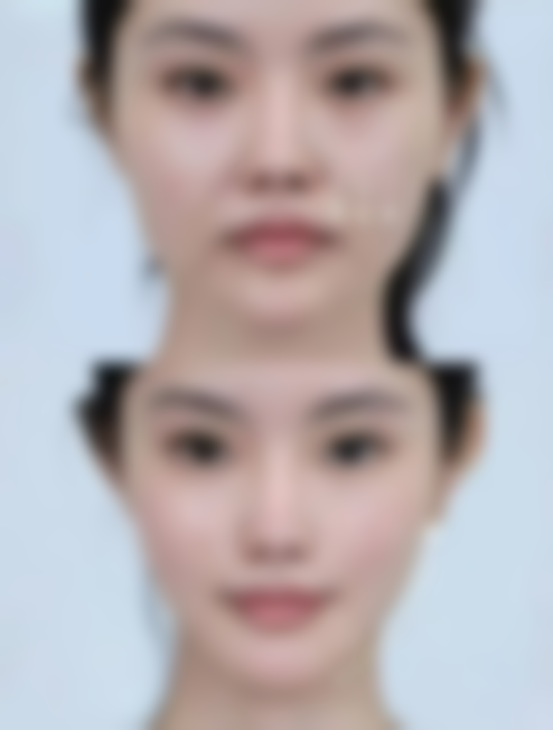 隆胸假体取出会损伤乳腺组织吗