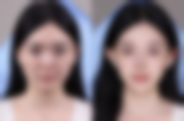 怎么样可以变成双眼皮呢——深圳米兰柏羽医疗美容门诊部