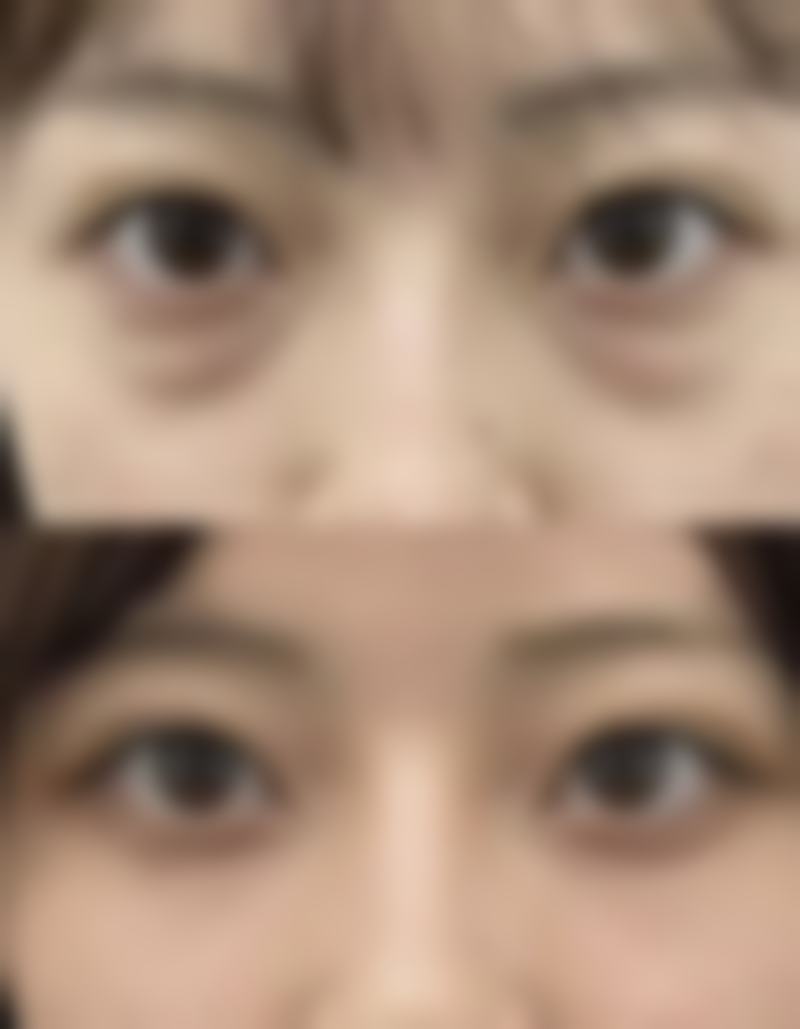 怎么样可以变成双眼皮呢——成都华颜医疗美容医院