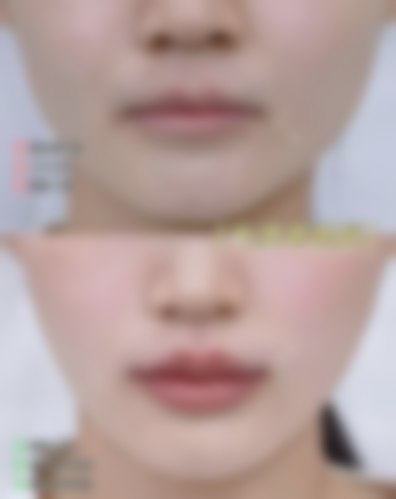 涂林医生做手术价格