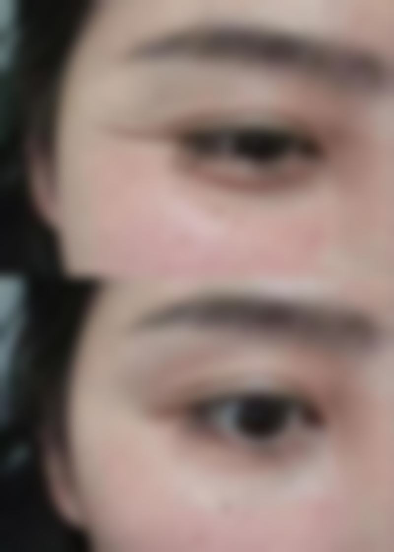 割双眼皮要肿多久——成都新华医院蔡灵