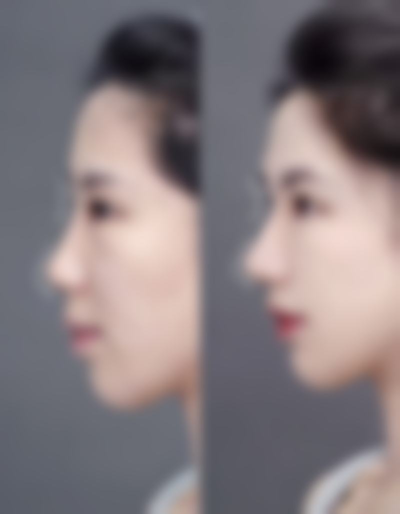 隆鼻整形后假体透光怎么办——重庆当代医疗美容方案