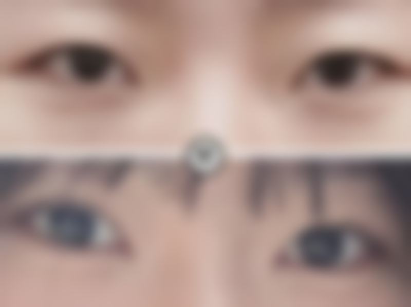 割双眼皮要肿多久——李欣豫