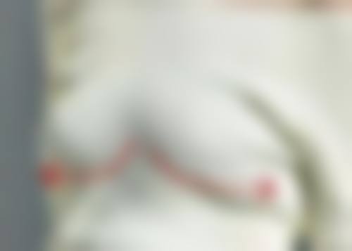 隆鼻修复包膜不吸收原因大剖析