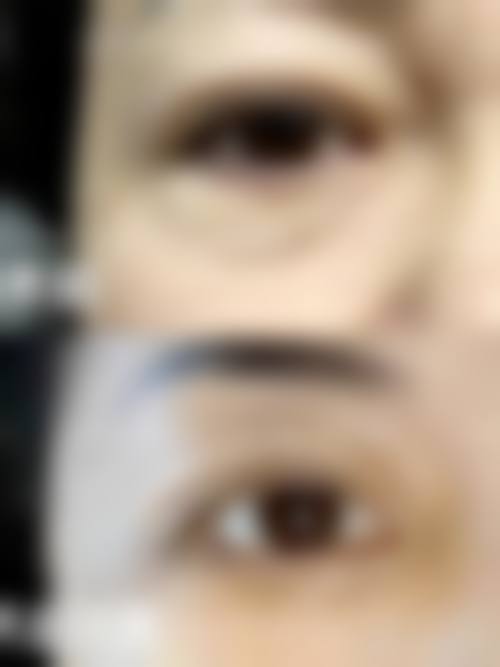 老年人下眼袋大怎么回事——艾雅医疗美容诊所