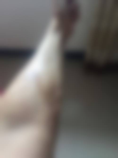 疤痕有什么方法可以去掉——上海美诗沁医疗美容医院