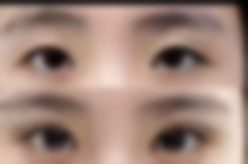 老年人下眼袋大怎么回事——仁爱医院