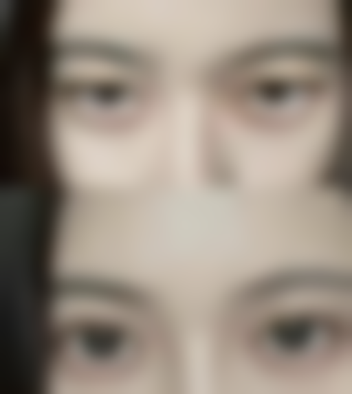 割双眼皮和割眼袋可以一起做吗——郑州郑美医疗美容医院