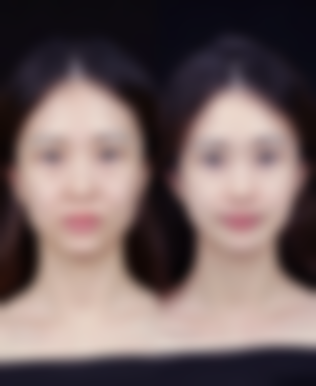 隆鼻修复包膜吸收必备条件解析