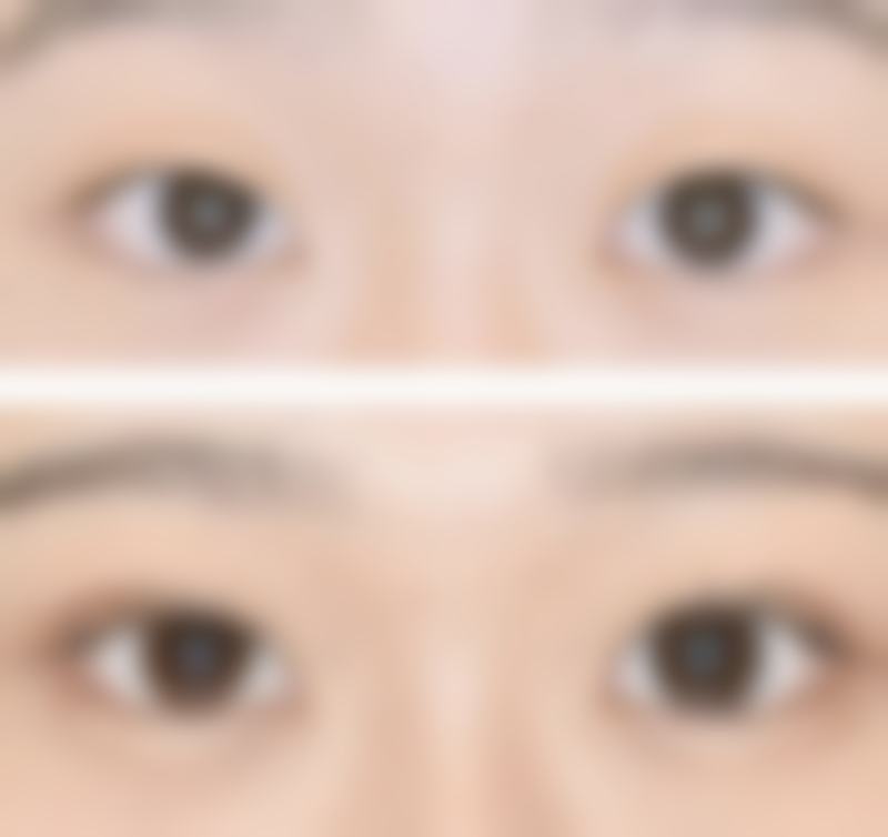 专科医院刀疤疤痕修复的精细方案