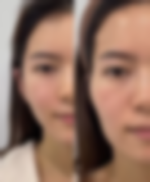 自体脂肪填充眼袋能保持多久——深圳广尔美丽医疗美容门诊部