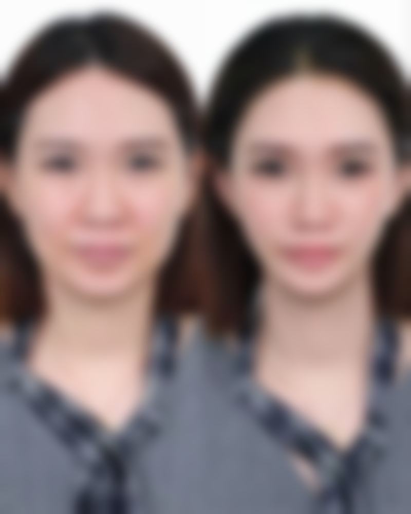 减肥后出现眼袋怎么办？按摩+冬瓜黑鱼羹双管齐下，轻松消除眼袋困扰