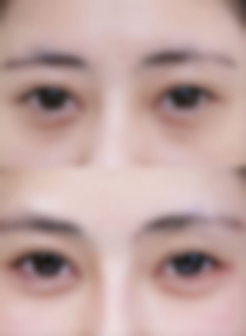 割双眼皮和割眼袋可以一起做吗——合肥壹加壹整形美容医院