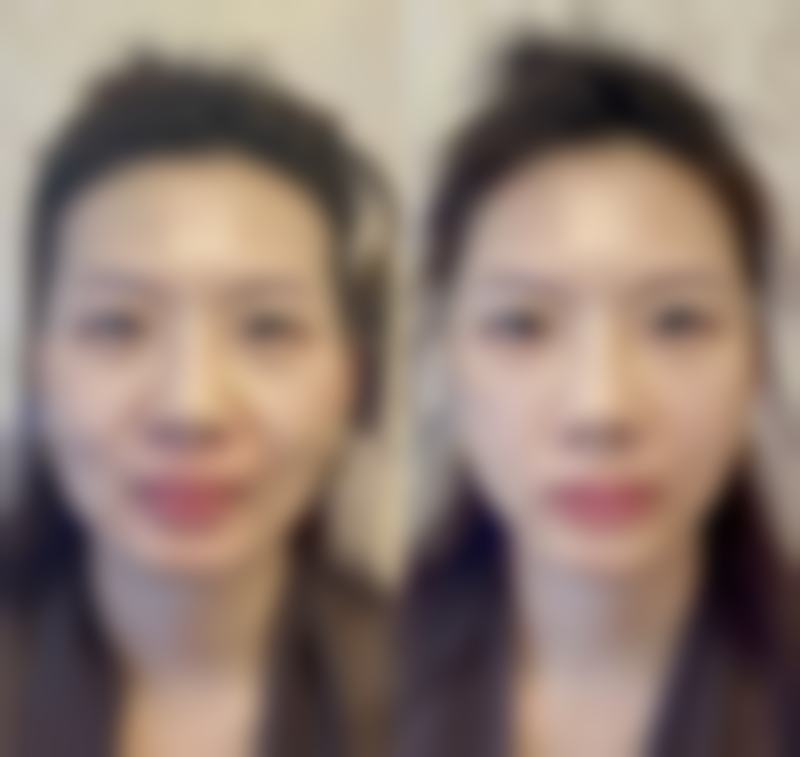 五、硅胶与盐水假体隆胸安心性综合考量