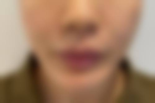 瘦脸针可以瘦屁股吗——深圳鹏爱医疗美容医院详情